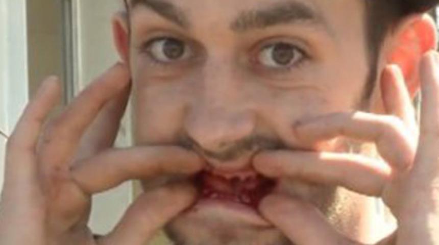 Bütün dişlerini çekti!