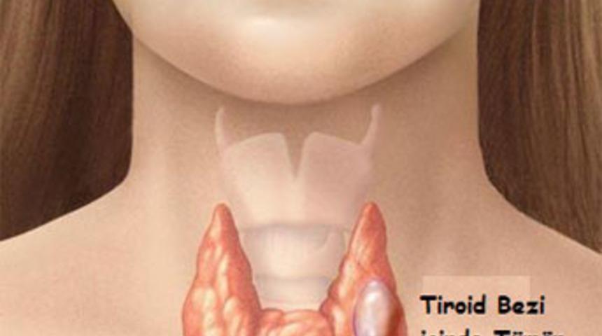 Tiroid kanserinde erkekler de risk altında