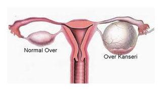 Yumurtalık kanserinin belirtilerine dikkat