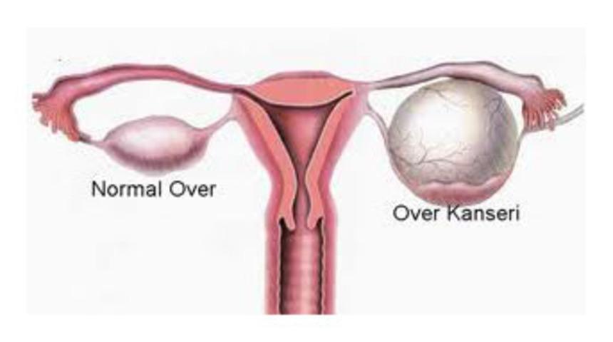 Yumurtalık kanserinin belirtilerine dikkat