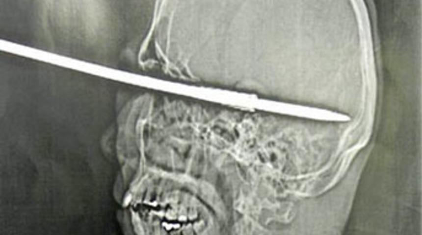 G&ouml;z&uuml;ne zıpkın saplandı!