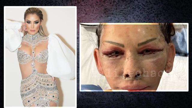 Yüz gençleştirme ameliyatı olmuştu! Petek Dinçöz'ün annesi Esra Süay Toğuş'un son hali gündem oldu! 'Evrim geçirmiş'