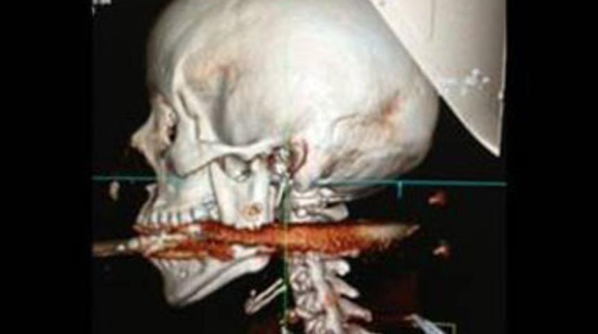 Ağzından zıpkınla vuruldu, kurtuldu