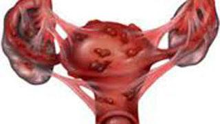 Çikolata kistlerine dikkat