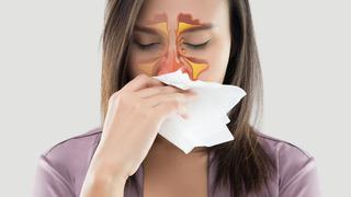 Sinüzit nedir, sinüzit belirtileri nelerdir? Sinüzit nasıl geçer? Sinüzit tedavisi