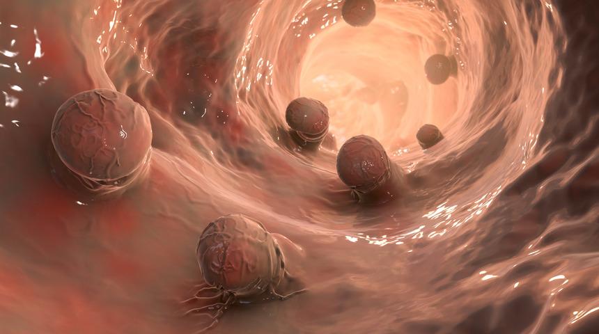 Polip nedir? Polip çeşitleri, polip belirtileri ve tedavi yöntemleri