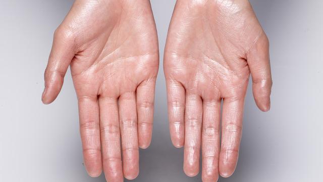 Elleriniz size ne anlatmak istiyor? Fazla terleyen avuç içleri o hastalığın işaretiymiş