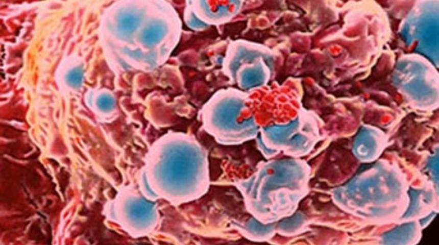 Yale Üniversitesi, metastaz'ın nedenini buldu