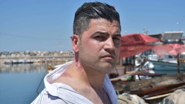 Lazer tedavisi kabus oldu! Güzel bir görünüme kavuşmak isterken bu hale geldi