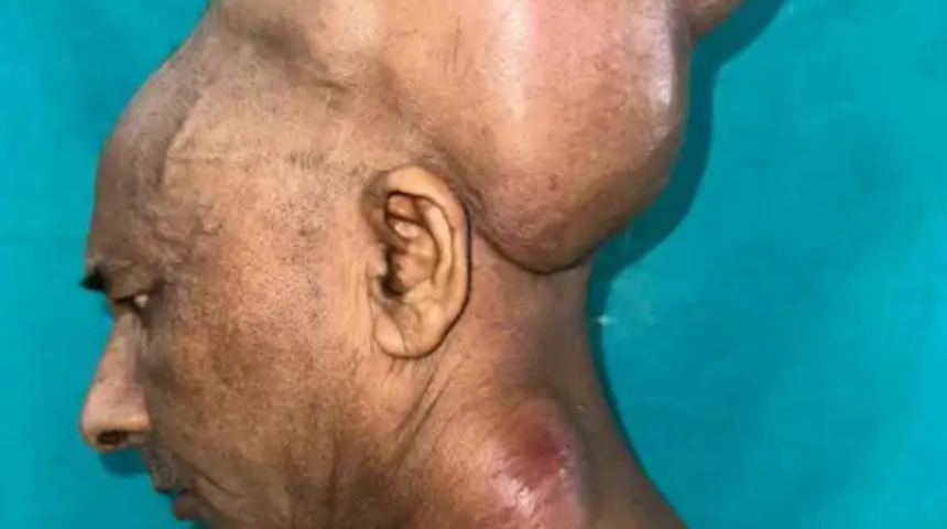 25 yıldır böyle yaşıyordu! Tam 6 kilogram ağırlığındaki tümör 10 saatlik ameliyatla ancak çıkartılabildi