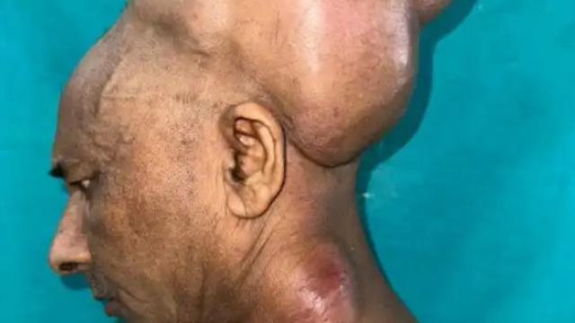 25 yıldır böyle yaşıyordu! Tam 6 kilogram ağırlığındaki tümör 10 saatlik ameliyatla ancak çıkartılabildi