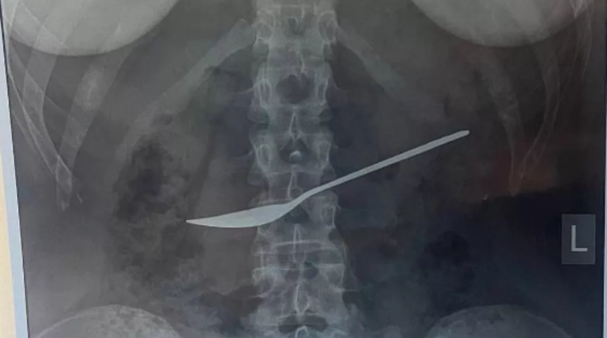 Karın ağrısı şikayetiyle hastaneye giden kızın midesinden tatlı kaşığı çıkartıldı! Doktorlar bile şaşkına döndü
