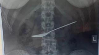 Karın ağrısı şikayetiyle hastaneye giden kızın midesinden tatlı kaşığı çıkartıldı! Doktorlar bile şaşkına döndü