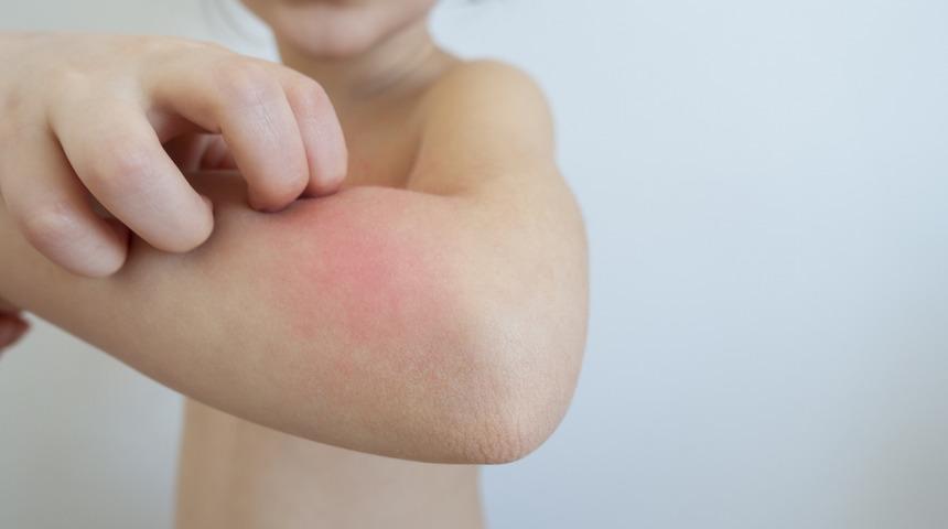 Son 20 yılda arttı: Besin alerjisi her 17 çocuktan birini etkiliyor! Bu besinlere aman dikkat