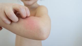 Son 20 yılda arttı: Besin alerjisi her 17 çocuktan birini etkiliyor! Bu besinlere aman dikkat