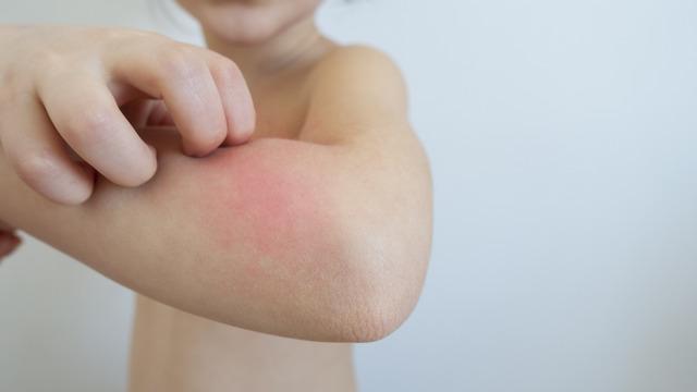 Son 20 yılda arttı: Besin alerjisi her 17 çocuktan birini etkiliyor! Bu besinlere aman dikkat
