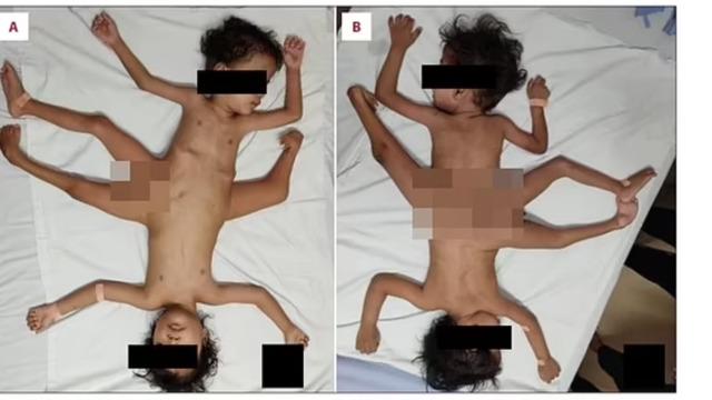 Tıp dünyasını şaşkına çeviren örümcek ikizler! Çok nadir görülüyor: Pelvis bölgesinden yapışıklar... Üç bacak, dört kol