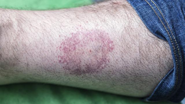 Hayalet hastalık olarak biliniyor! Türkiye'de yaygın görülüyor… Bu belirtilere dikkat! Kene, sinek ve böceklerden bulaşıyor