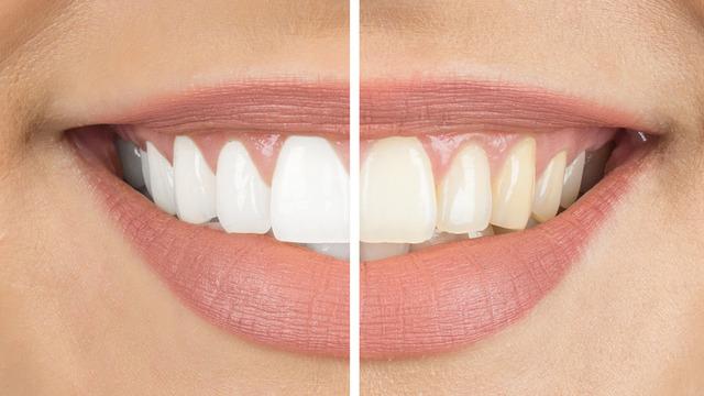 Uzmanlar uyardı: Bilinçsiz diş beyazlatmalara dikkat!