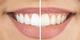 Uzmanlar uyardı: Bilinçsiz diş beyazlatmalara dikkat!