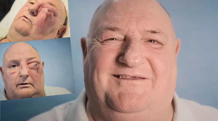 Dayanılmaz bir diş ağrısı hissediyordu! Diş enfeksiyonu yayıldıktan sonra et yiyen hastalık nedeniyle gözü şişti