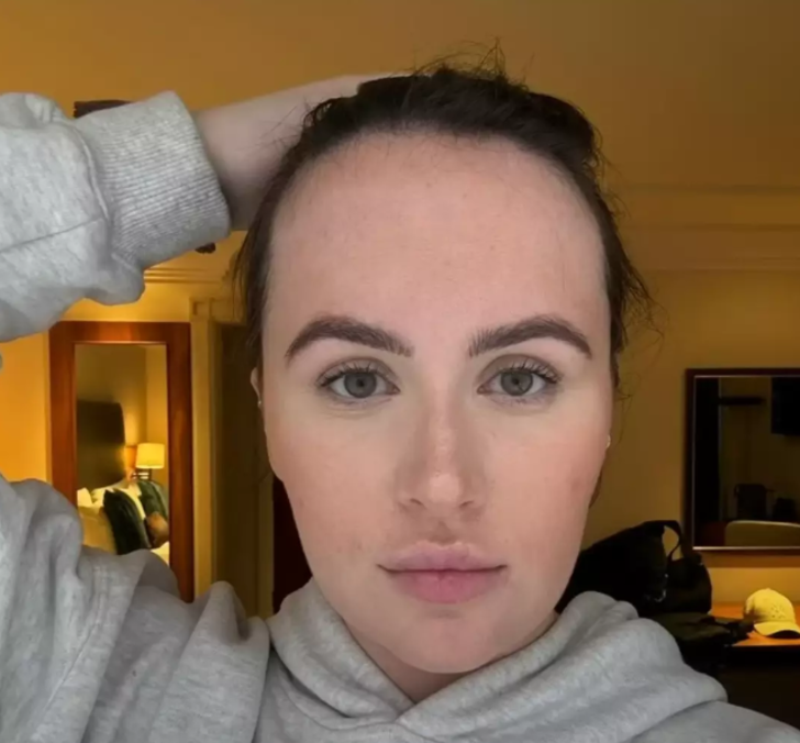 Alnının genişliğinden &ccedil;ok rahatsızdı! &Ccedil;areyi estetik cerrahi de buldu... Alın daraltma operasyonun sonu&ccedil;larını paylaşınca viral oldu