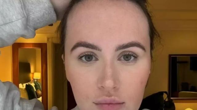 Alnının genişliğinden çok rahatsızdı! Çareyi estetik cerrahi de buldu... Alın daraltma operasyonun sonuçlarını paylaşınca viral oldu