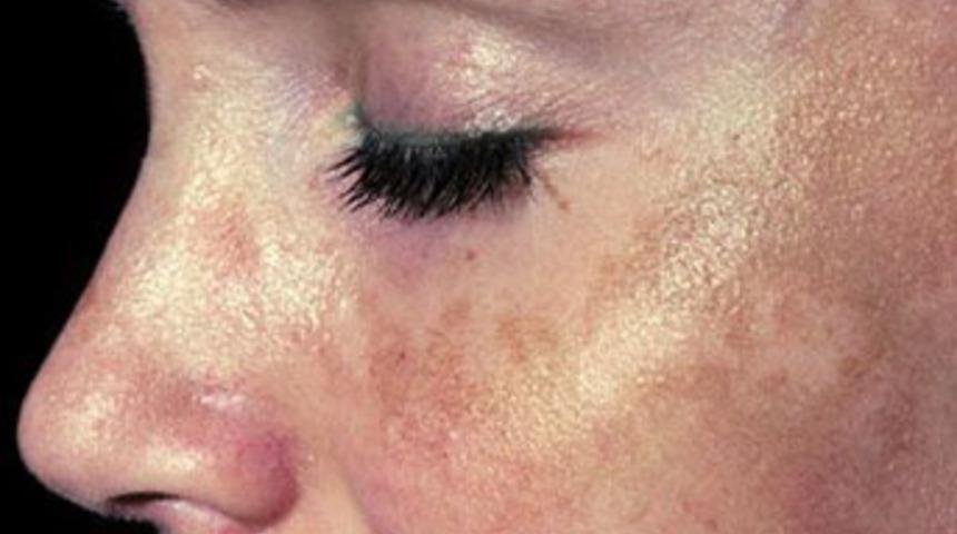 Cilt lekelerine mucize çözümler