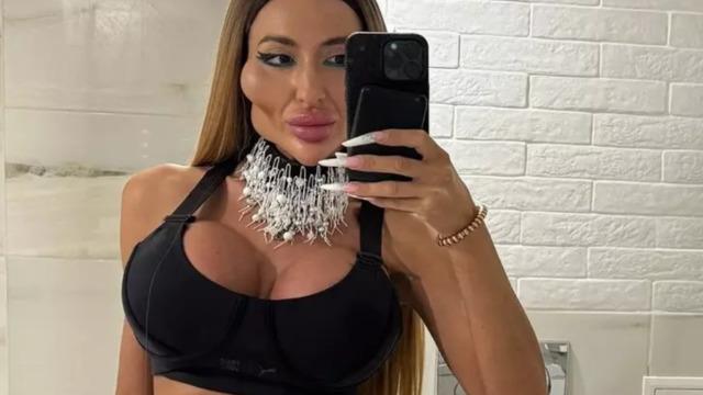 Dünyanın en büyük yanaklı modeli Anastasia Pokreshchuk'un estetiksiz hali görenleri şaşkına çevirdi