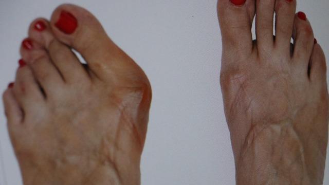 Ayakkabı seçerken dikkat: Parmağınızın anatomisi bozulabilir! Özellikle kadınlarda görülüyor