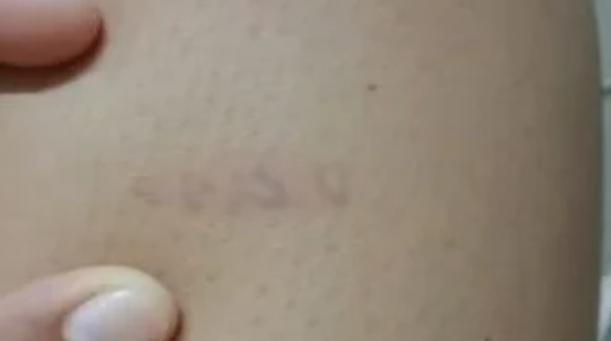 Bacağındaki yanık izlerinin büyük ikramiyenin şanslı rakamları olduğunu iddia etti! Sosyal medyada tartışmanın fitilini ateşledi