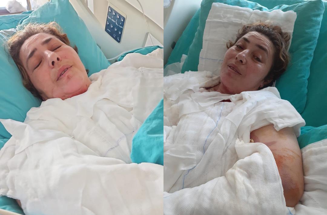 D&uuml;d&uuml;kl&uuml; tencere bomba gibi patladı, &ouml;l&uuml;mden kıl payı kurtuldu! V&uuml;cudunun y&uuml;zde 40'ı yandı