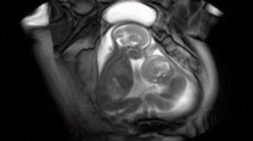 Anne karnında yer kavgası