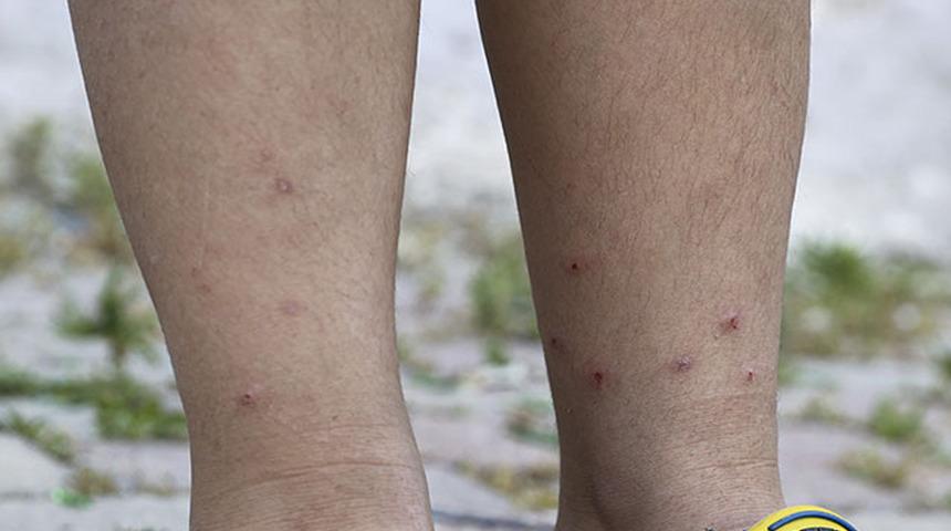 'Böcek ısırdı' deyip geçmeyin! Bu belirtilere dikkat... 'Tehlikeli' sonuçları var