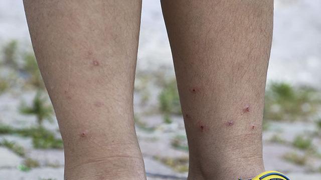'Böcek ısırdı' deyip geçmeyin! Bu belirtilere dikkat... 'Tehlikeli' sonuçları var