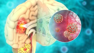 Beyin tümörü belirtileri nelerdir? Beyin tümörü tedavisi