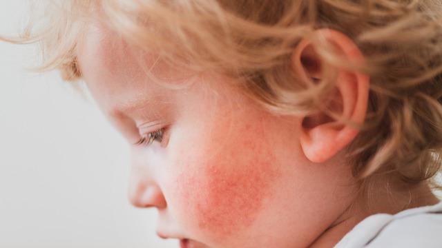 Beşinci hastalık nedir? Beşinci hastalık belirtileri ve tedavisi
