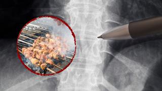 Mangal keyfi ölümle sonuçlanıyordu! Bir parça tavuk yedi sesini kaybetti... Herkesin başına gelebilir: Sakın bu hatayı yapmayın! 