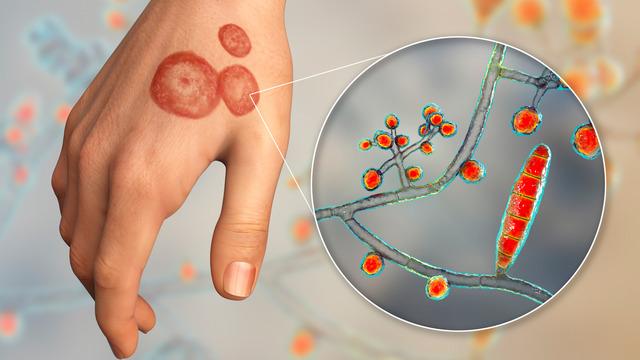 Yeni bir tür ortaya çıktı... İlk vaka haberi ABD'den! Son derece bulaşıcı