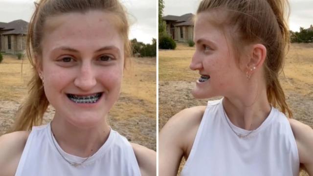 O eski halinden eser yok! Çene ameliyatının sonuçlarını gösterdi... Gören inanamadı: Resmen evrim geçirmiş