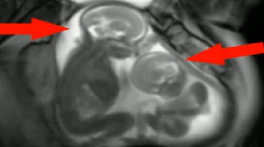 İkizlerin anne karnında kavgası