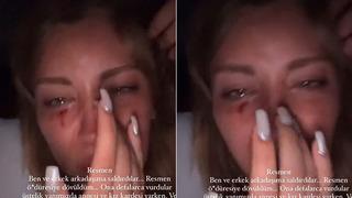 Mika Raun kanlar içinde video paylaştı! Öldüresiye dövüldüm, defalarca vurdular...