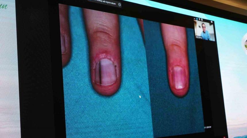 Cildiye profesörü uyardı! Tırnak dibinde görülen siyah lekeye dikkat: O hastalığın öncüsü olabilir