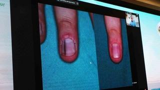 Cildiye profesörü uyardı! Tırnak dibinde görülen siyah lekeye dikkat: O hastalığın öncüsü olabilir