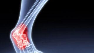 Romatizmal ağrılara bitkisel tedaviler