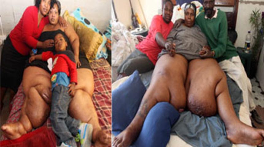 Fil hastası kadınların dramı