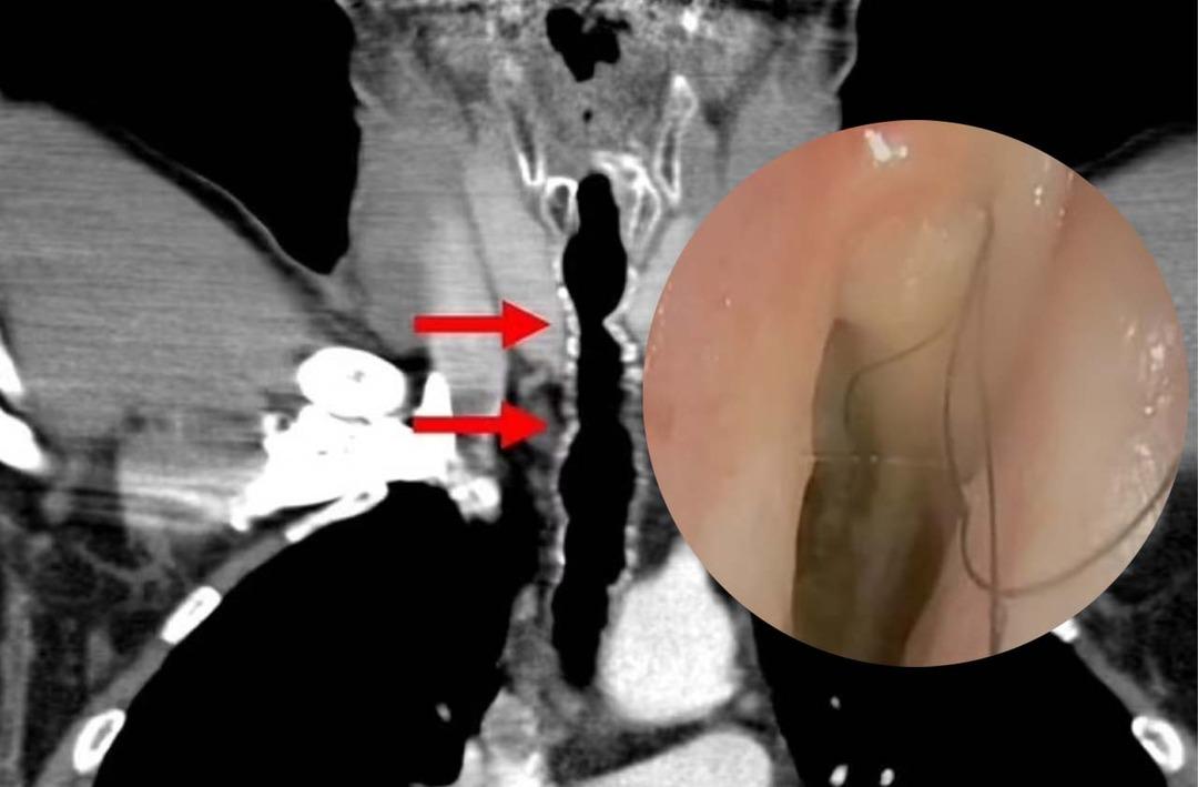 Akılalmaz olay: Boğazında durmadan &ccedil;ıkan sa&ccedil;lar doktorları bile şaşkına &ccedil;evirdi! 14 yıl boyunca devam etti... Yalnızca iki kişide g&ouml;r&uuml;ld&uuml;