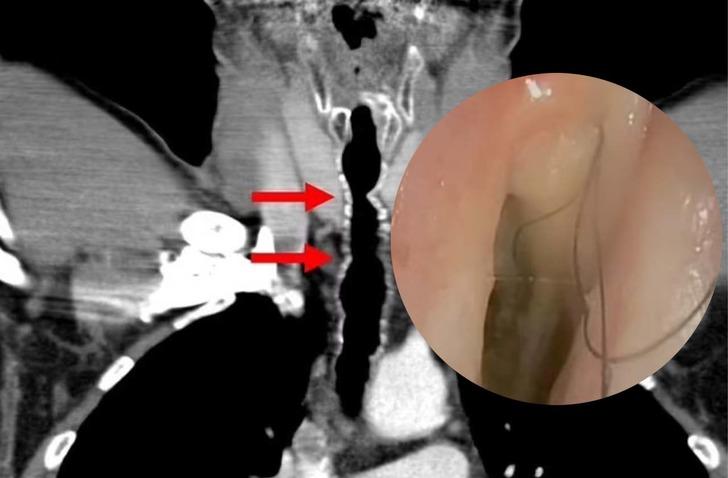 Akılalmaz olay: Boğazında durmadan çıkan saçlar doktorları bile şaşkına çevirdi! 14 yıl boyunca devam etti... Yalnızca iki kişide görüldü