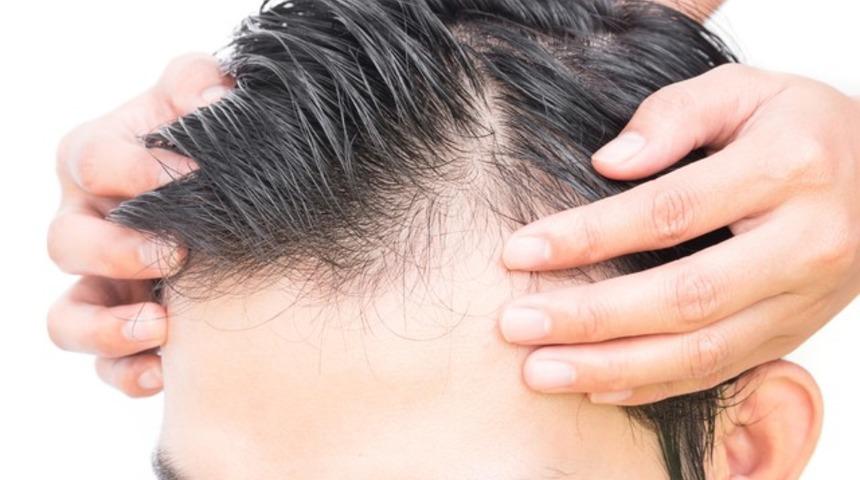 Saç ekiminde 'iğneli kalem tekniği' dönemi!