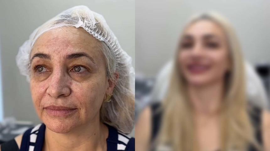 Estetikle değişimin bu kadarı da pes dedirtti! Neredeyse 30 yaş gen&ccedil;leşti